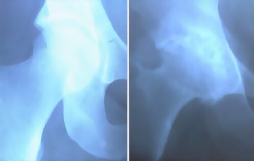 снимок артроза коленного сустава